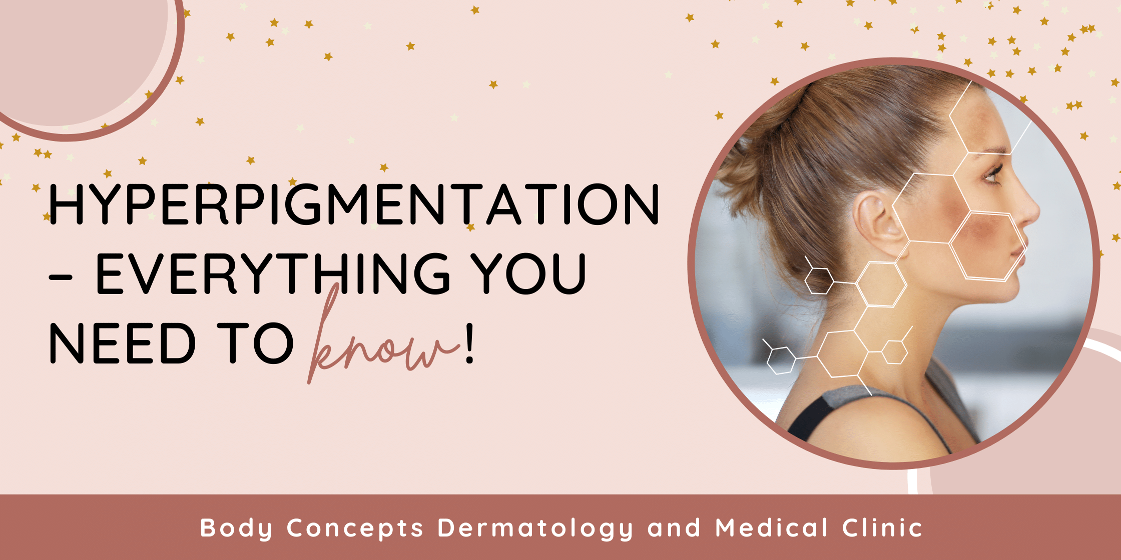 Hyperpigmentation – everything you need to know! | Body Concepts Dermatology and Medical Clinic | Dr. Pag-asa Bernardo-Bagolor | San Rafael, Bulacan